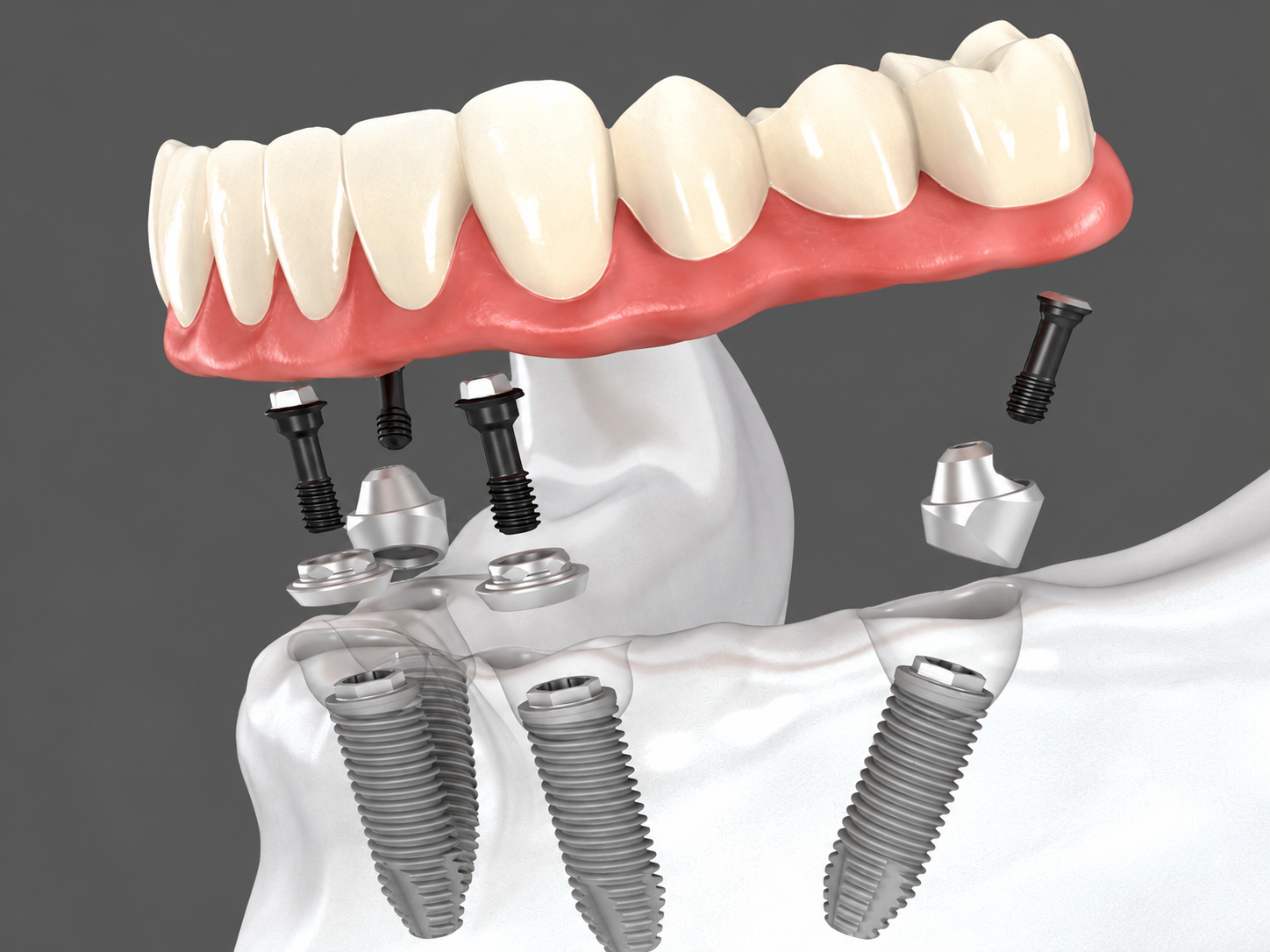Arcadă dentară și componentele de fixare deasupra a patru implanturi