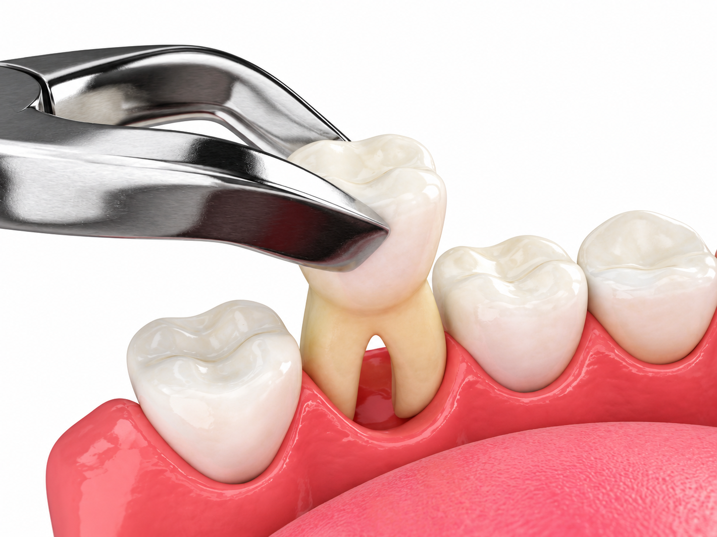 Extracție dentară cu clește — ilustrație