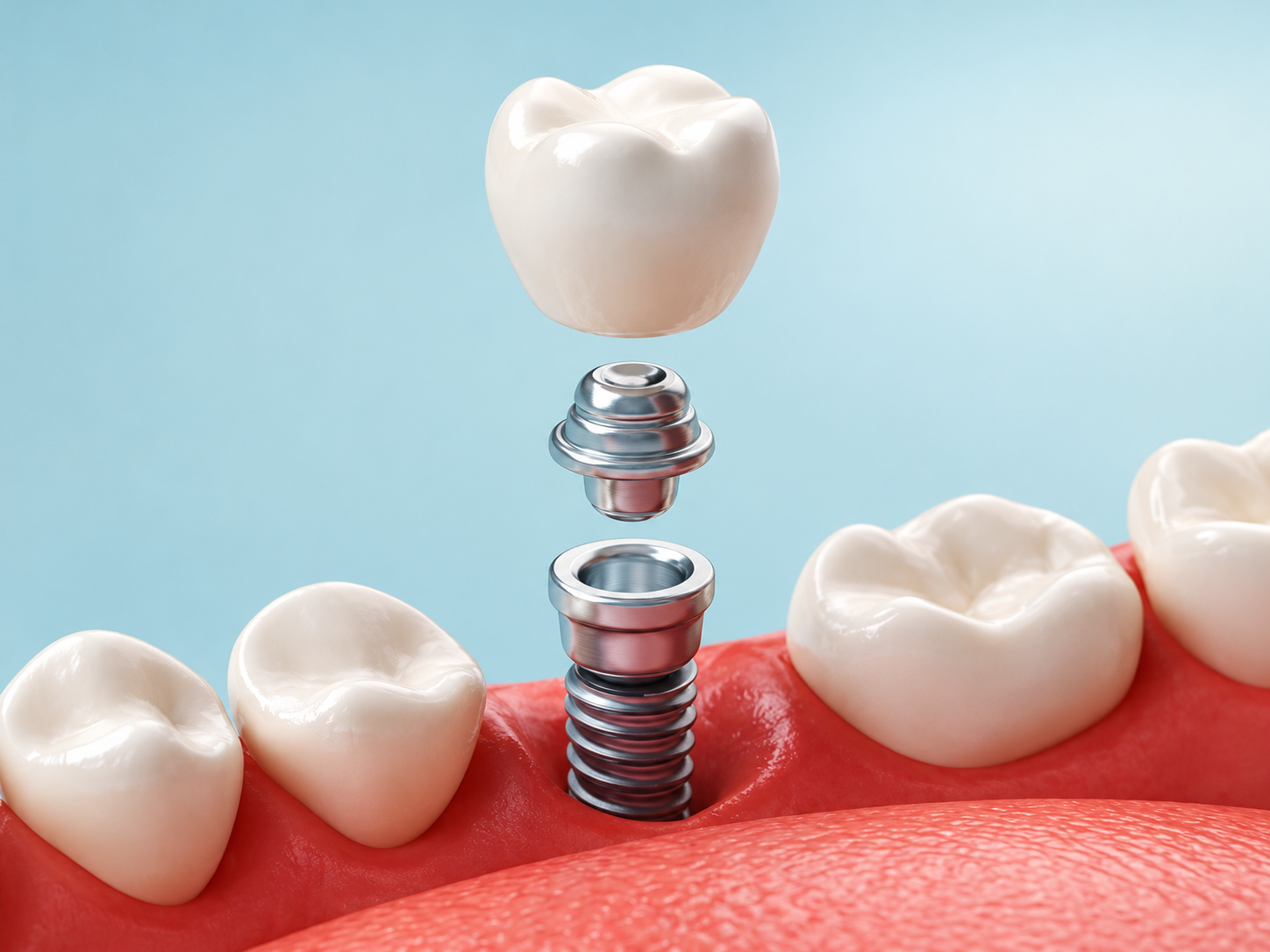 Ilustrație cu implantul dentar, bontul și coroana